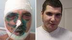 30-летнему мужчине, искалеченному в драке, хирурги собрали новое лицо из металла