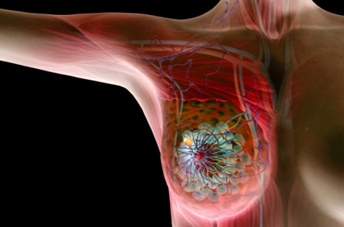 Рак молочной железы – выход может быть найден